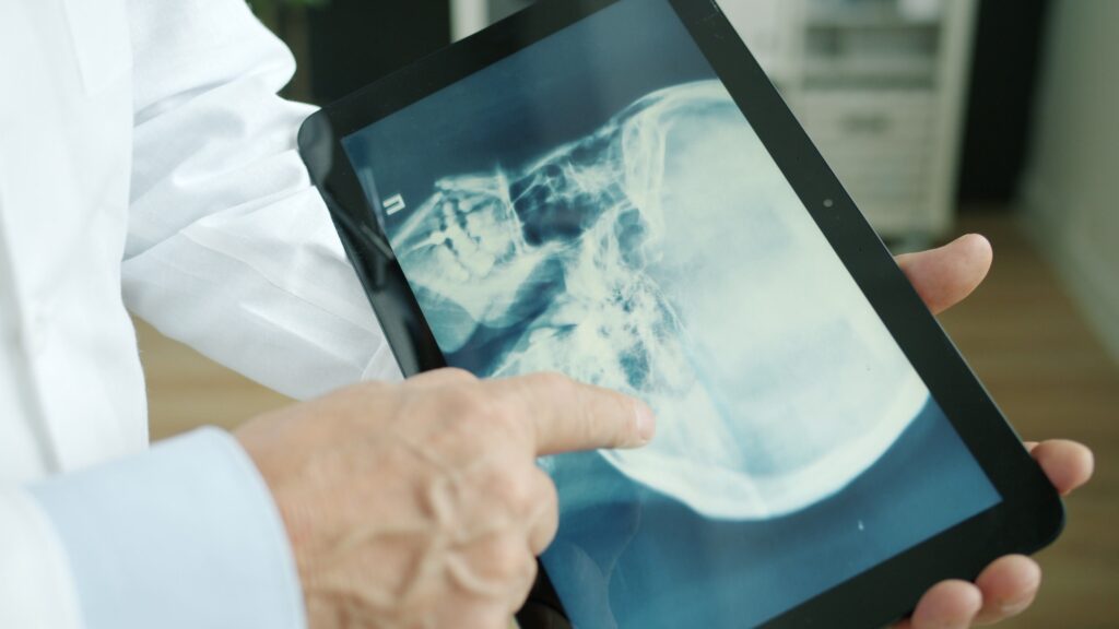 Doctor pointing to a skull X-ray on a tablet while reviewing delayed concussion symptoms after a New Jersey motorcycle accident.